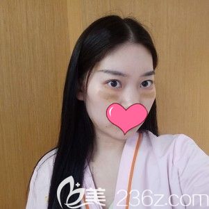 杨斐主任帮我做内切法去眼袋术后即刻效果