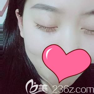 做内切去眼袋术后15天眼袋消失皮肤恢复弹性