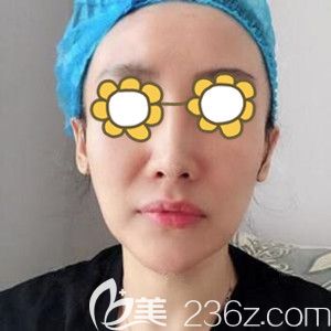 做面部埋线提升术前照 做面部埋线提升术前照