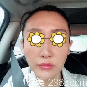 做面部埋线提升术后5天效果图 做面部埋线提升术后5天效果图