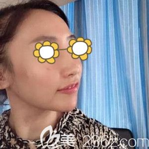 做面部埋线提升术后半个月恢复效果图 做面部埋线提升术后半个月恢复效果图