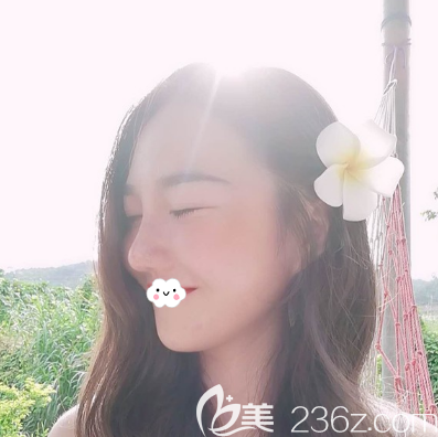成都艾米丽硅胶假体+耳软骨垫鼻尖术后一个月 成都艾米丽硅胶假体+耳软骨垫鼻尖术后一个月
