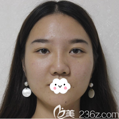 成都艾米丽假体隆鼻术前正面照 成都艾米丽假体隆鼻术前正面照