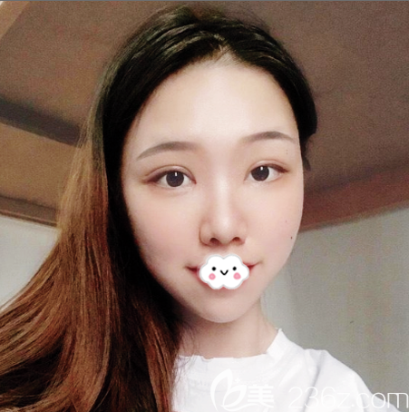 深圳艺星常德成双眼皮案例7天拆线效果