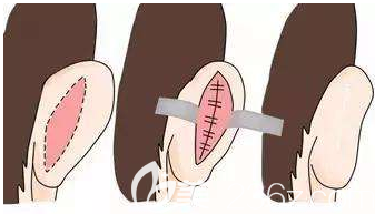 耳朵畸形的手术示意图