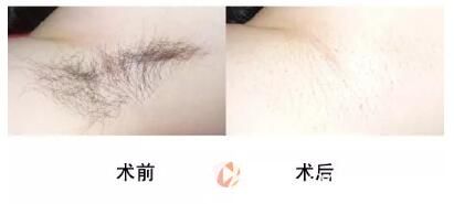 许昌博爱整形激光脱毛真人案例