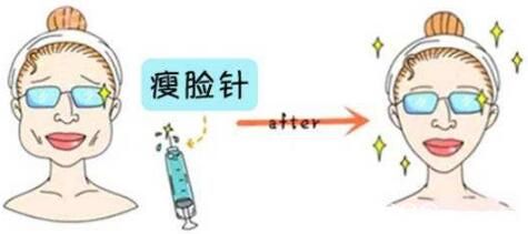 为什么有些人注射瘦脸没有效果? 为什么有些人注射瘦脸没有效果?