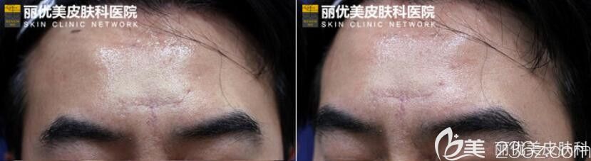 疤痕在韩国丽优美皮肤科采用DNA真皮再生术效果超乎想象