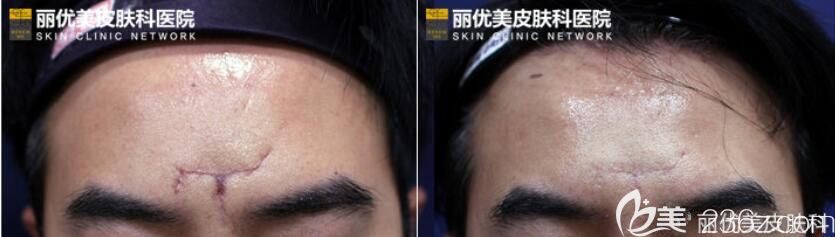 韩国丽优美皮肤科DNA真皮再生术去疤痕怎么样
