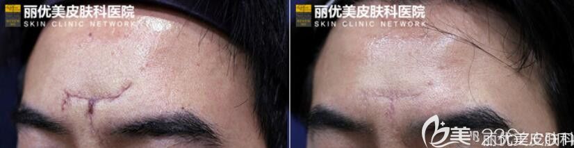 韩国丽优美皮肤科DNA真皮再生术去疤痕