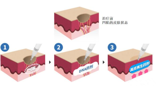 DNA真皮再生术