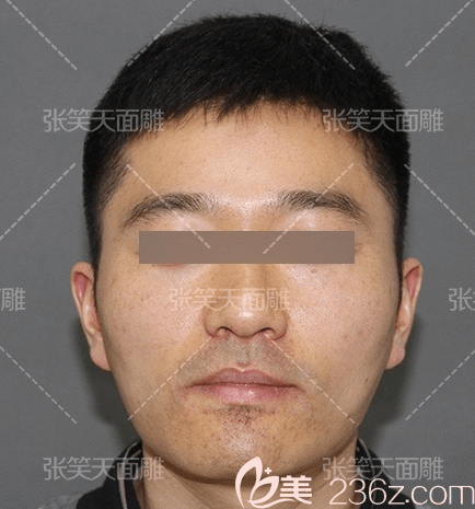 我在北京圣嘉新做颧骨颧弓内推+下颌角前样子 我在北京圣嘉新做颧骨颧弓内推+下颌角前样子