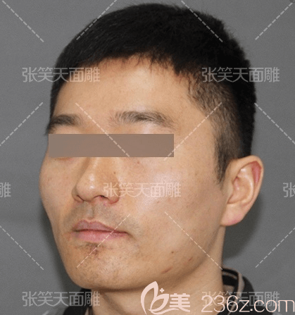 张笑天医生给我做颧骨颧弓内推+下颌角前侧面样子 张笑天医生给我做颧骨颧弓内推+下颌角前侧面样子