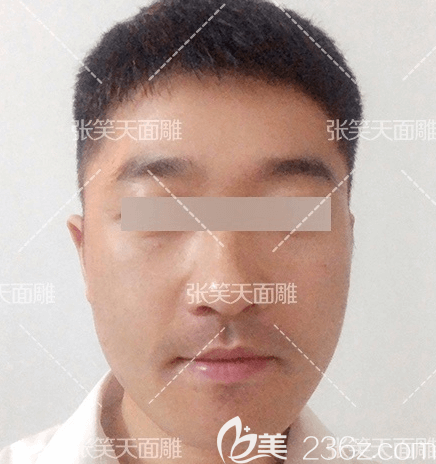 我在北京圣嘉新做颧骨颧弓内推+下颌角第30天效果 我在北京圣嘉新做颧骨颧弓内推+下颌角第30天效果