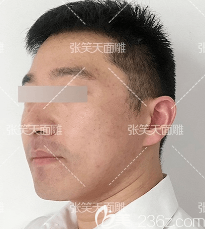 北京圣嘉新张笑天医生颧骨颧弓内推＋下颌角整形案例