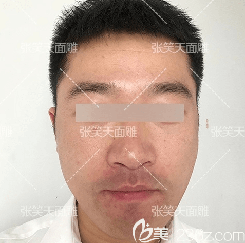 张笑天磨骨多少钱?我在北京圣嘉新做颧骨颧弓内推+下颌角拿到磨骨价格表和效果参考 张笑天磨骨多少钱?我在北京圣嘉新做颧骨颧弓内推+下颌角拿到磨骨价格表和效果参考