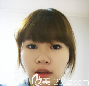 韩国爱婷做鼻子怎么样 韩国爱婷做鼻子怎么样