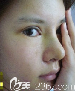 韩国爱婷鼻子双眼皮脂肪填充颧骨6个月日记 韩国爱婷鼻子双眼皮脂肪填充颧骨6个月日记