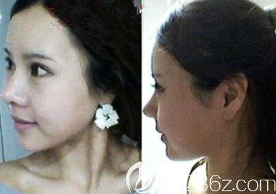 韩国爱婷鼻子双眼皮脂肪填充真人案例