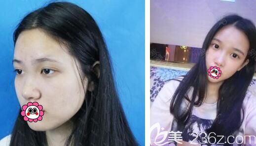 合肥韩美假体隆鼻案例 合肥韩美假体隆鼻案例