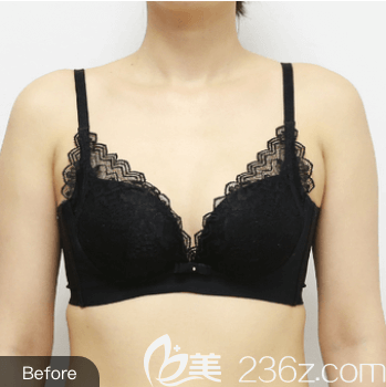 我在北京圣嘉新做自体脂肪丰胸前样子 我在北京圣嘉新做自体脂肪丰胸前样子