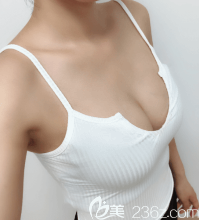 北京圣嘉新李朕自体脂肪丰胸案例 北京圣嘉新李朕自体脂肪丰胸案例