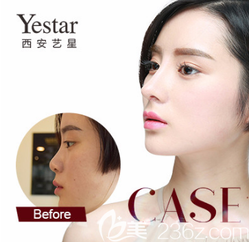 准备！西安艺星8月份整形价格表来袭+鼻综合只需7777元而已