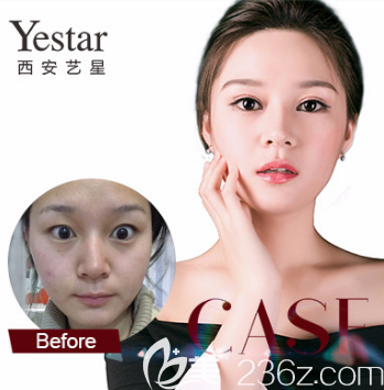 西安艺星隆鼻案例