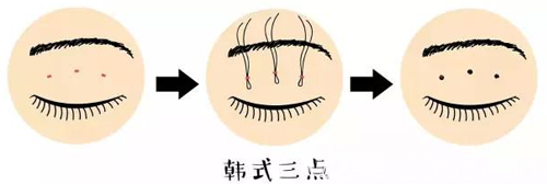 韩式三点式双眼皮手术方法示意图