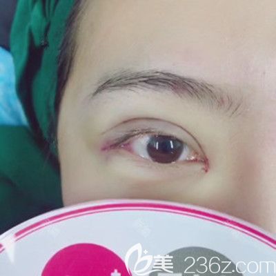 在洛阳毛大夫做眼综合手术当天