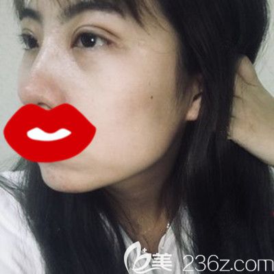 在洛阳毛大夫做眼综合手术15天后