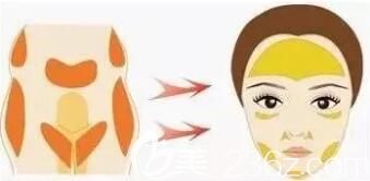 自体脂肪面部填充术