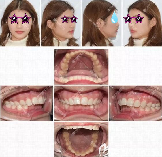 牙齿矫正前面型图和口内照片.jpg 牙齿矫正前面型图和口内照片.jpg