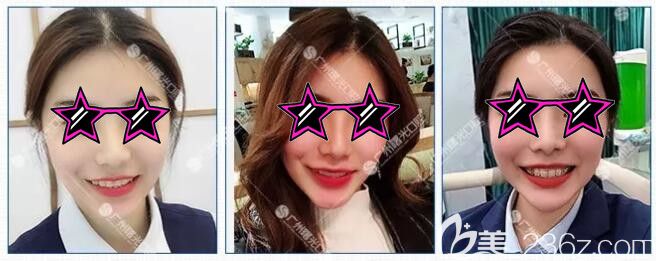 深覆合矫正过程中 深覆合矫正过程中