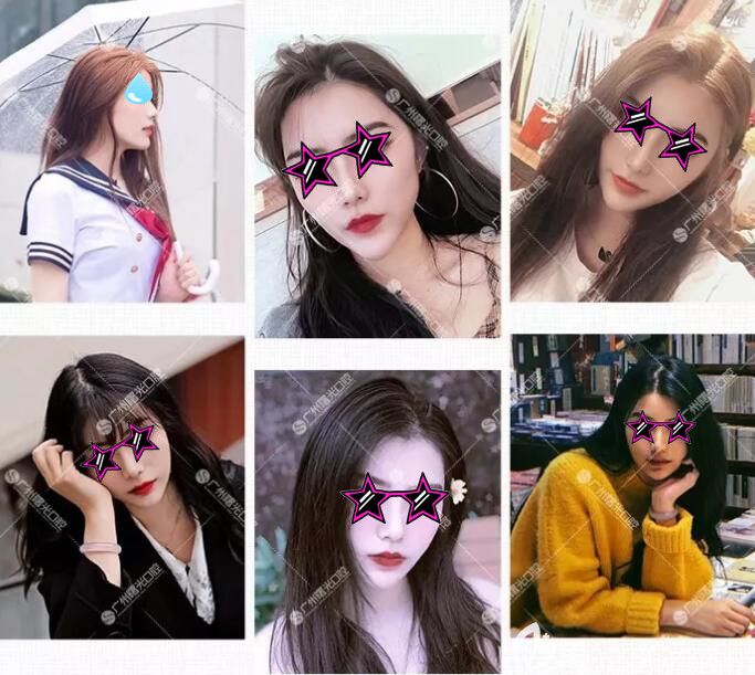 在广州曙光口腔做了深覆合矫正后像垫下巴，有我深覆合矫正前后脸型对比图为证哦