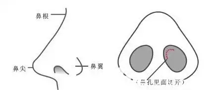单纯隆鼻示意图 单纯隆鼻示意图