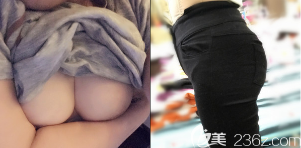 说我脂肪量充足腰腹吸脂后我选择自体脂肪丰胸和自体脂肪丰臀一起做
