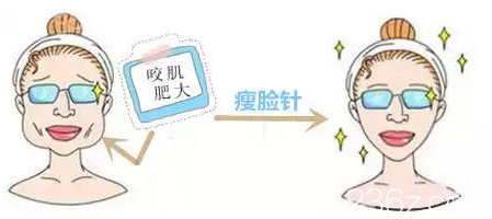 咬肌肥大的人注射瘦脸的样子