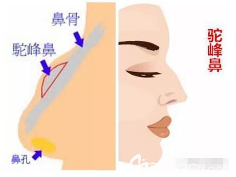 什么是驼峰鼻 什么是驼峰鼻