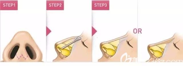 假体植入改善驼峰鼻 假体植入改善驼峰鼻