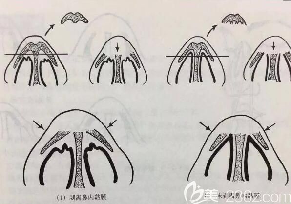 截骨法改善驼峰鼻手术原理 截骨法改善驼峰鼻手术原理