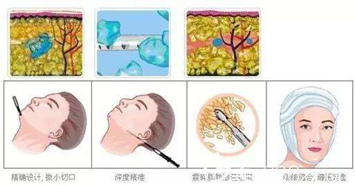 面部吸脂瘦脸的原理