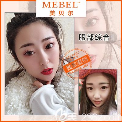 苏州美贝尔眼综合案例 苏州美贝尔眼综合案例