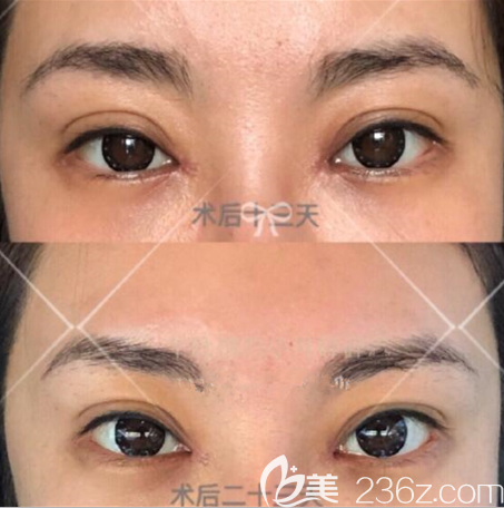 韩国eve郑润载眼角修复好吗