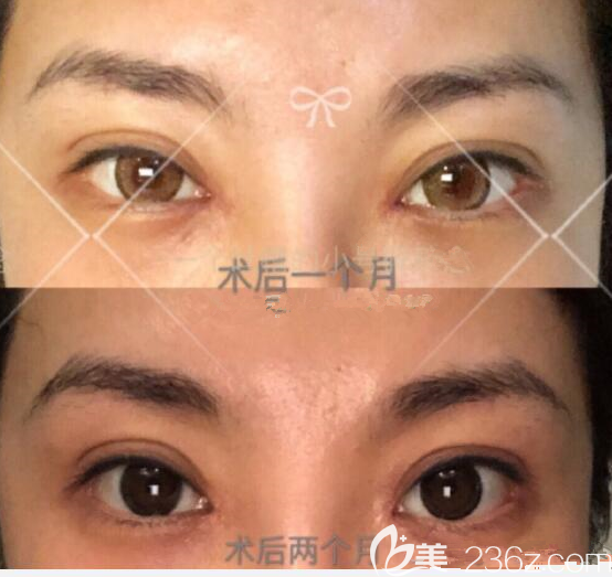 韩国eve郑润载做眼角修复真人案例