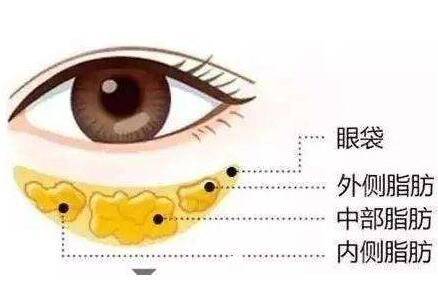 韩式手术去眼袋效果怎么样？好不好？