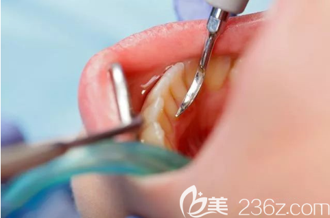 牙结石治疗