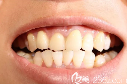 牙齿清洁健康非常重要