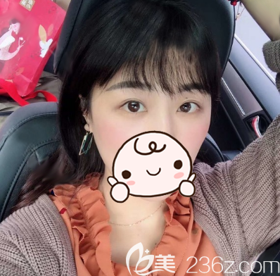 找王家勇做了大腿吸脂术后效果理想就又做了内切祛眼袋