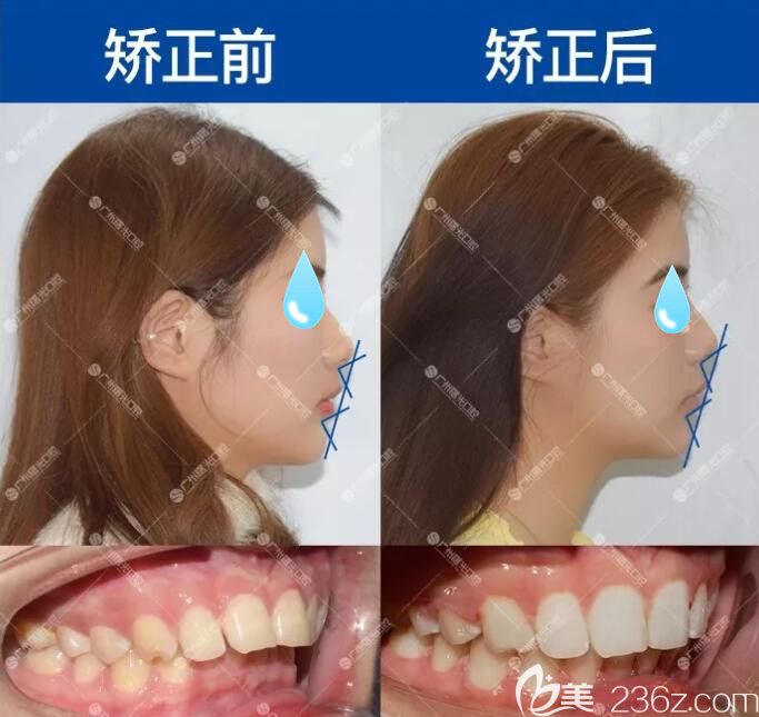 曙光口腔员工通过半隐形陶瓷矫正深覆合案例 曙光口腔员工通过半隐形陶瓷矫正深覆合案例